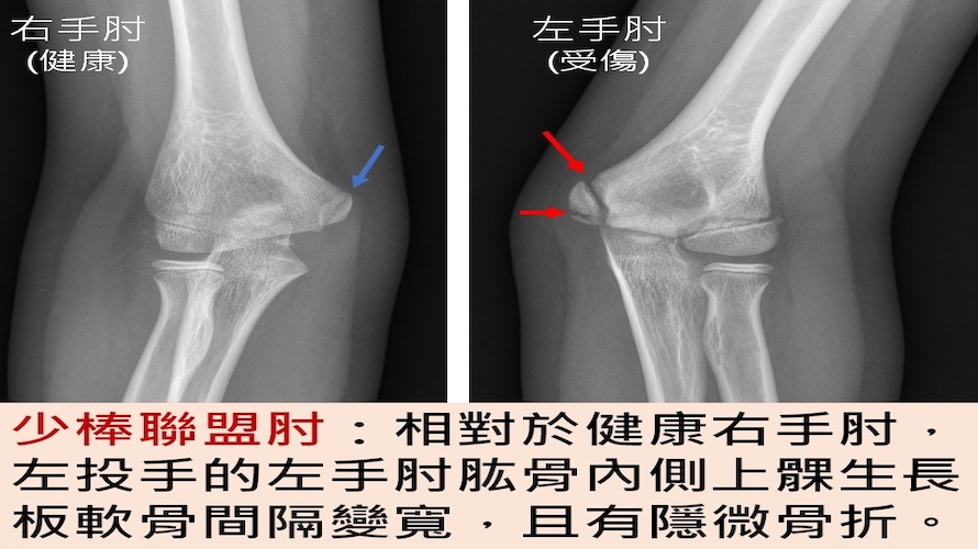 手肘內側疼痛勿輕忽     監測疲勞預防「少棒聯盟肘」